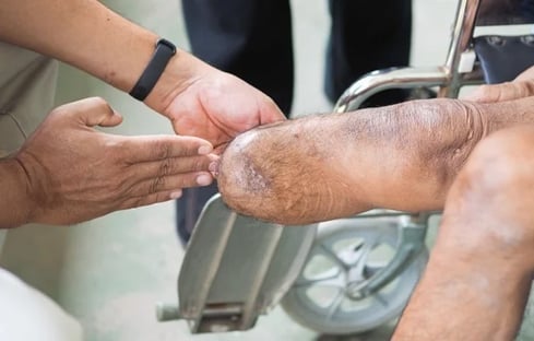 3-training-for-prosthesis-device-600x384